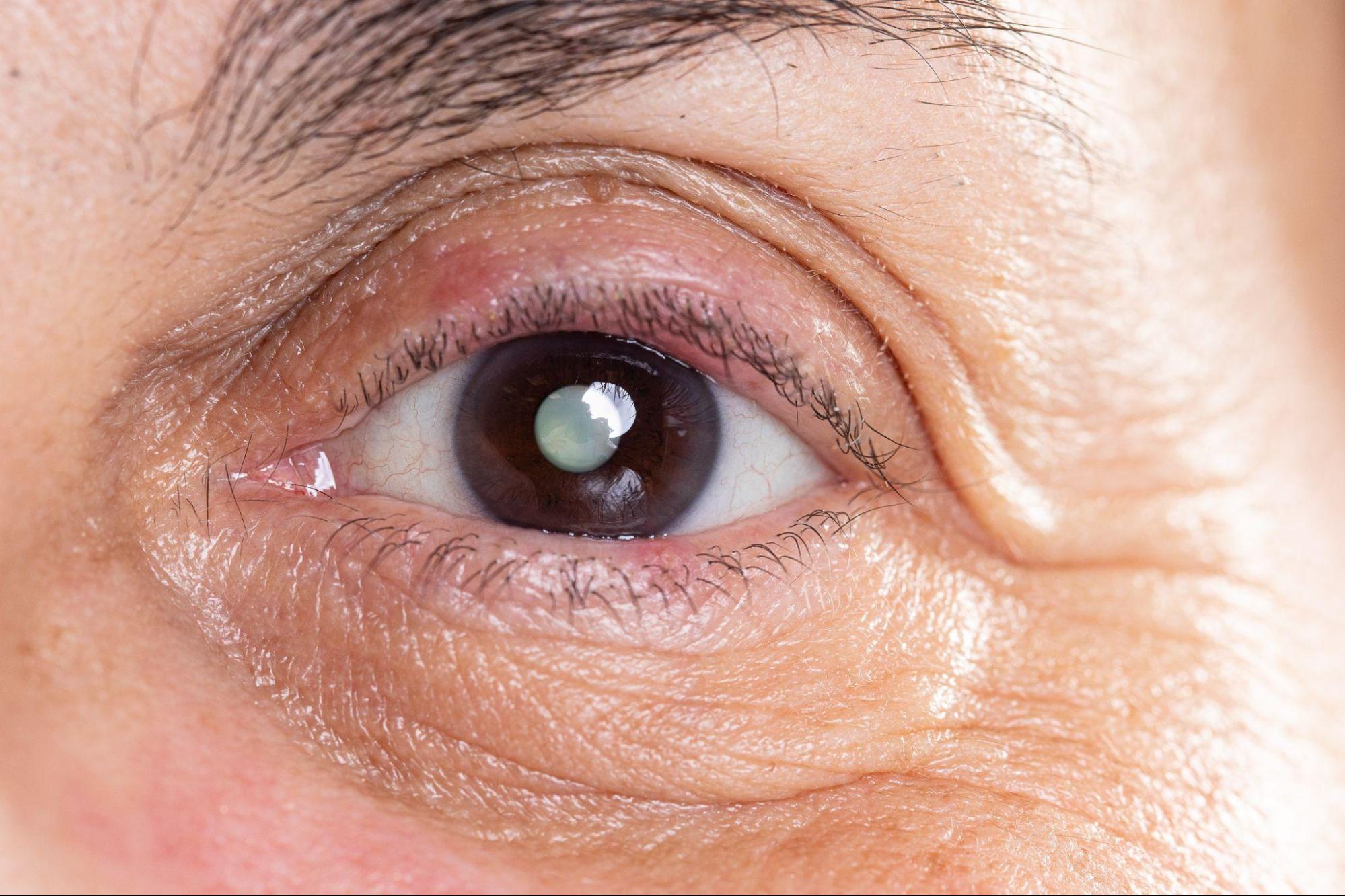 Discover the Possible Causes of Cataracts in Your 40s