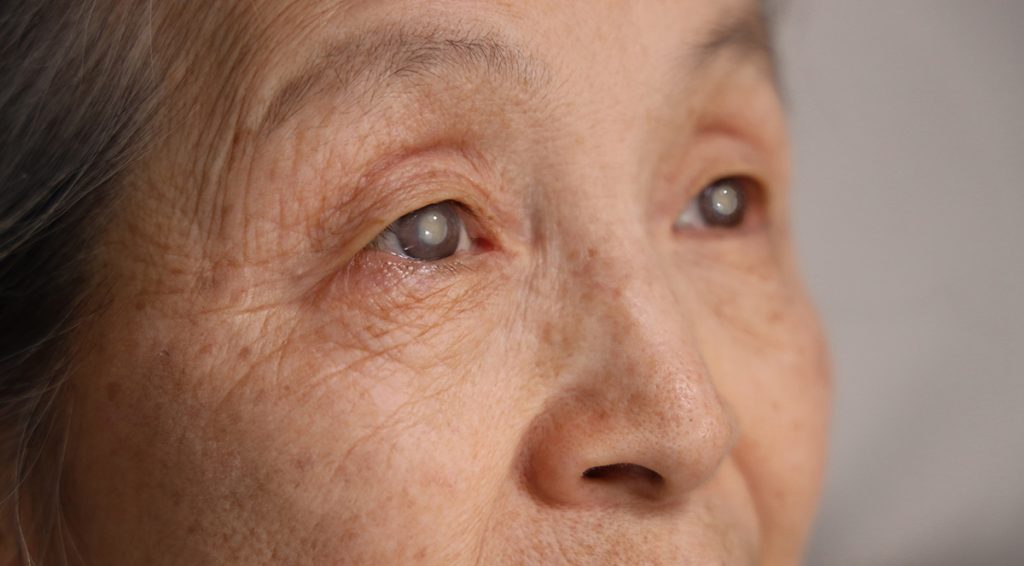 Elderly-woman's-eye-with-cataracts