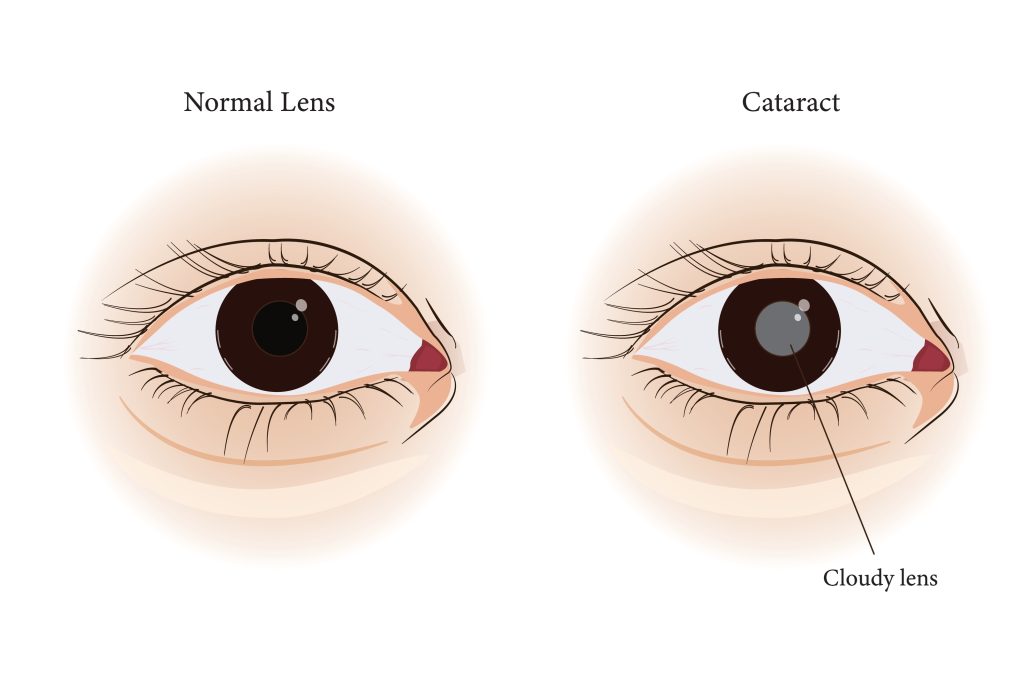 Image comparing between healthy eyes and eyes affected by cataracts