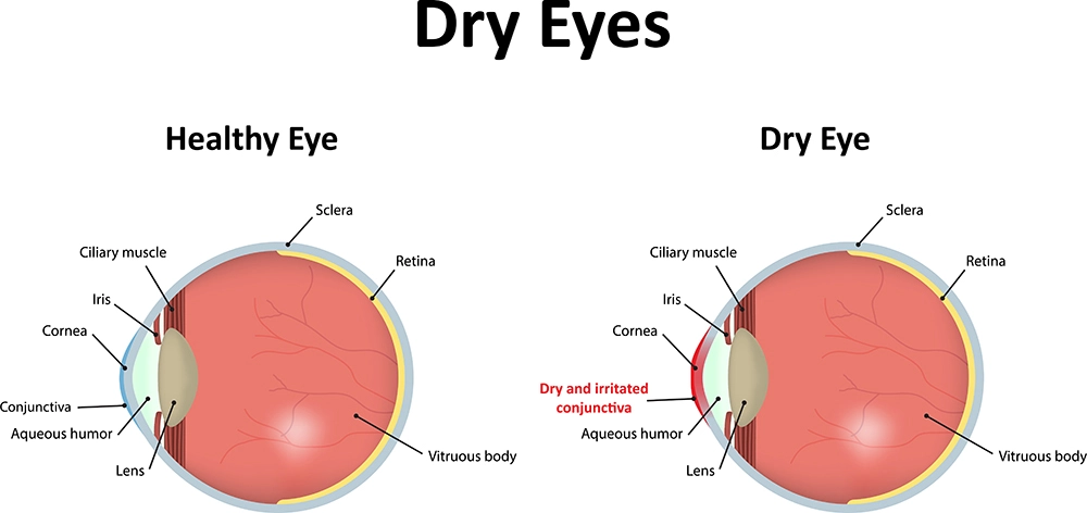 Comparison diagram of a healthy eye and dry eye showing tear film instability and irritated ocular surface