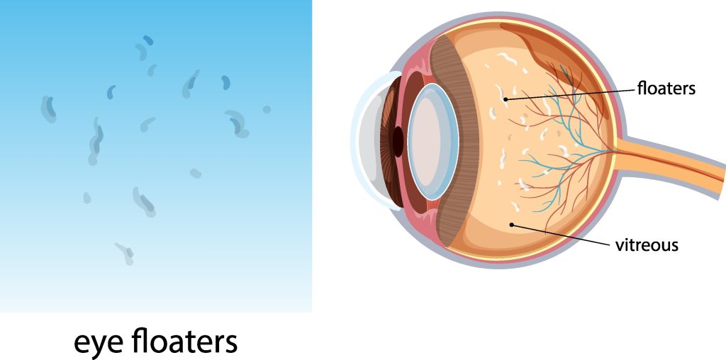 Diagram of eye floaters in the vitreous gel of the eye