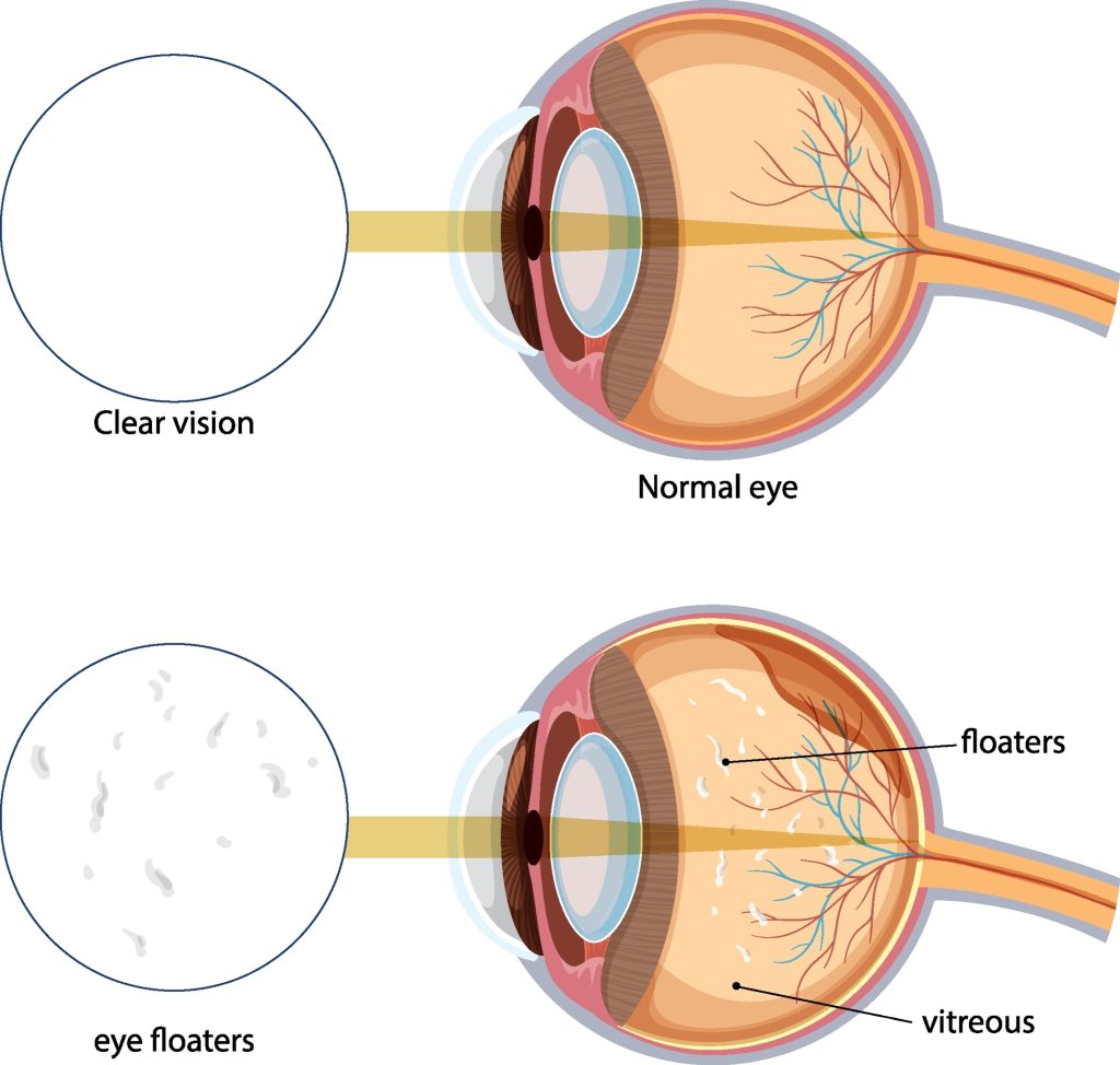 Diagram comparing clear vision with vision affected by eye floaters
