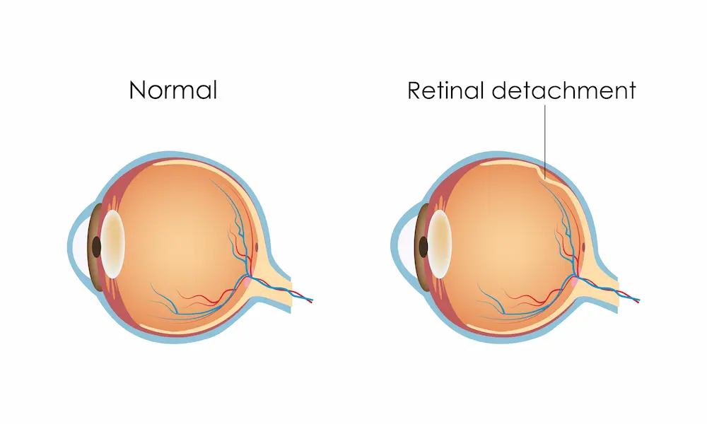 retinal detachment illustration vs normal eye