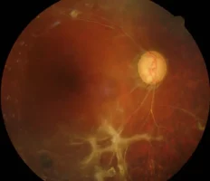 Glaucoma2-768x661.jpg