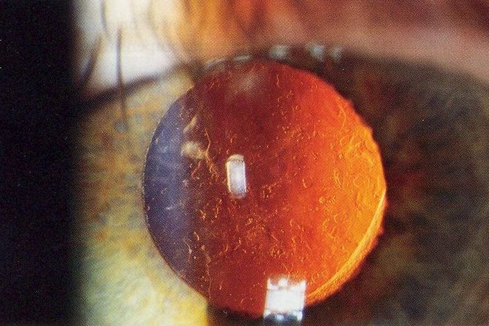Diagram showing clear posterior capsule after successful cataract surgery with IOL in position