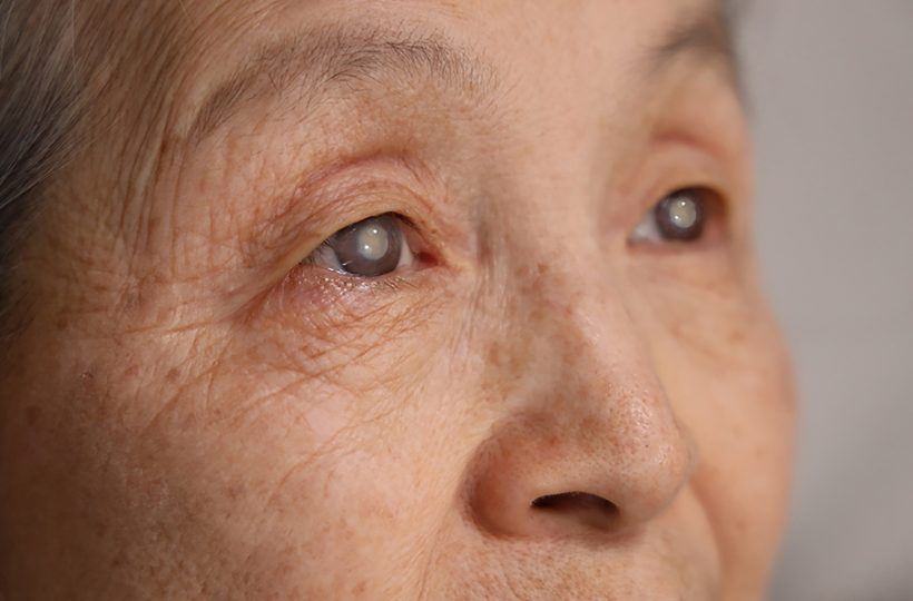 Cataract Surgery & Lens Conditions