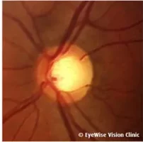 pic_glaucoma-1-e1649923249965.jpg