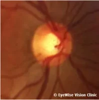 pic_glaucoma-e1649923240819.jpg